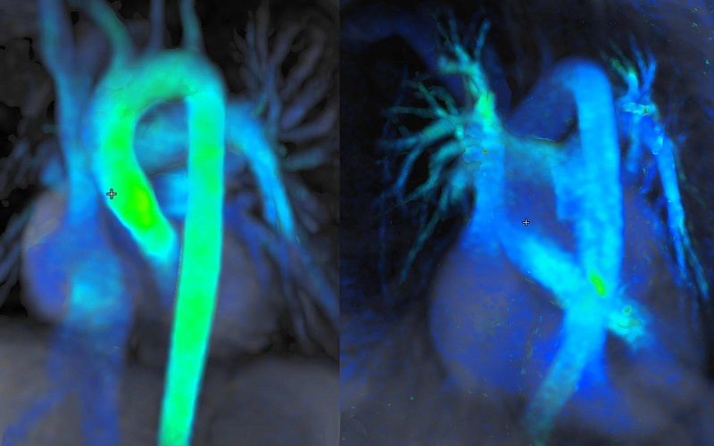 Imagen de los flujos sanguíneos dentro del corazón obtenida mediante la secuenciación 4D Flow