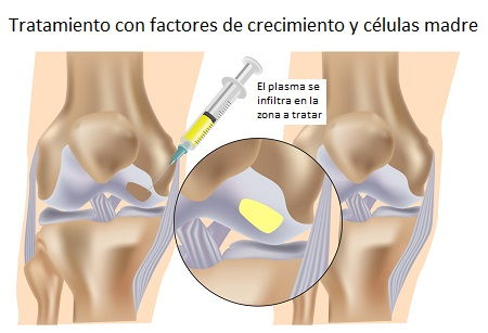 Resultados del tratamiento con factores de crecimiento y células madre
