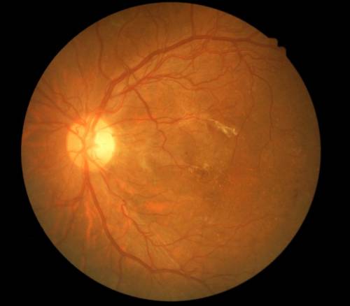 Retinopatía diabética en los ojos