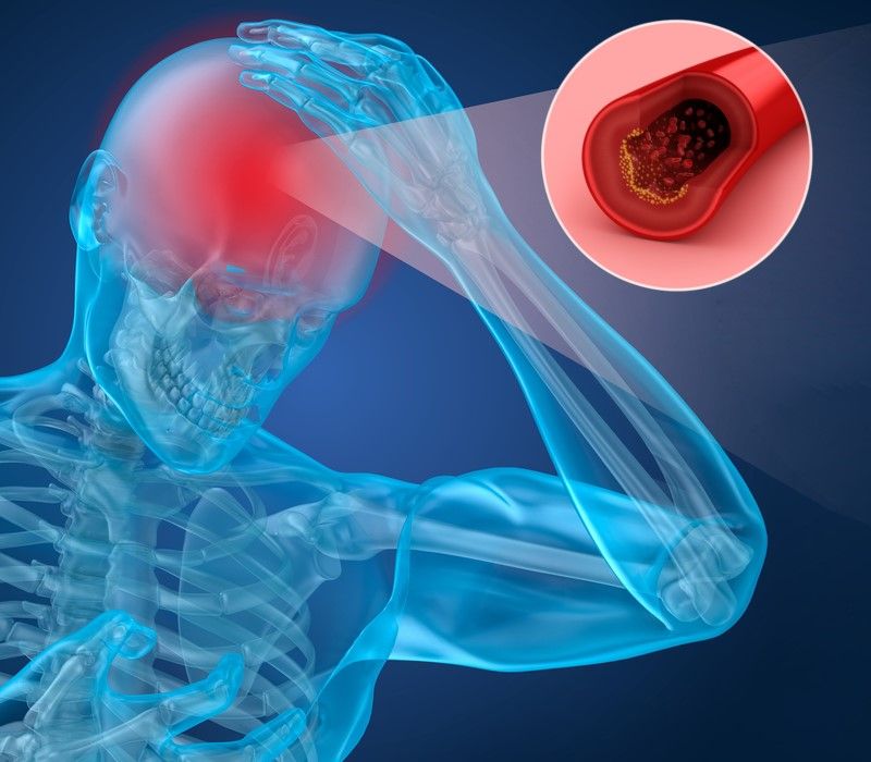 Riesgos del ictus y su prevención