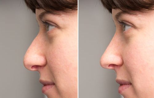 Rinoplastia, antes y después