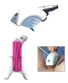 Ilustración de la sesión de ondas de choque