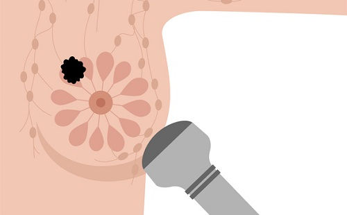 La ecografía con ultrasonidos, una de las técnicas de diagnóstico en el cáncer de mama