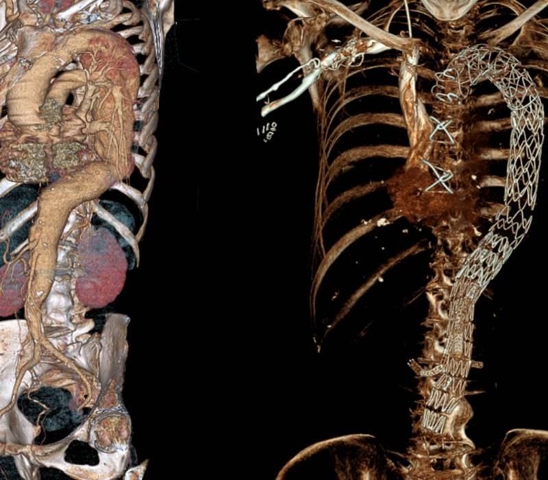 Sustitución de la aorta completa para tratar un aneurisma