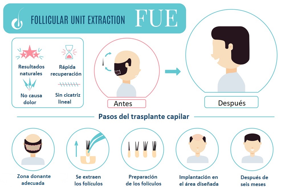 Técnica FUE de trasplante capilar