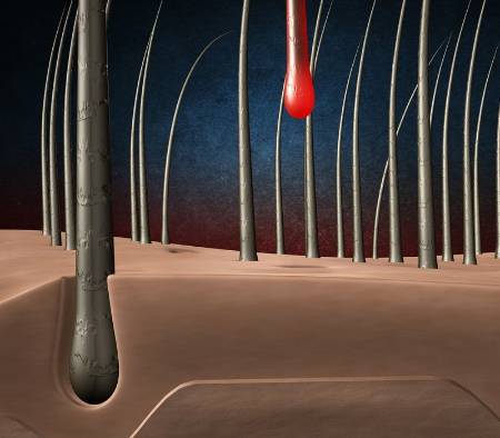 ¿Qué tipos de alopecia o calvicie son habituales en mujeres?