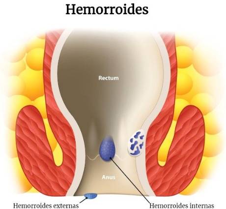 Tipos de hemorroides
