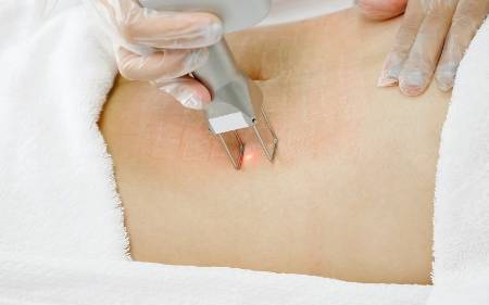 Tratamiento láser CO2 para eliminar estrías