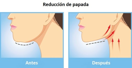 Tratamiento de reducción de papada