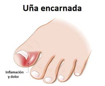 La enfermedad de uñas encarnadas