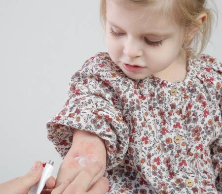 Urticaria crónica espontánea: causas, diagnóstico y tratamiento