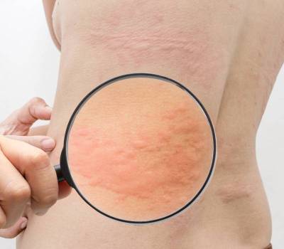 Imagen de una persona con urticaria crónica espontánea