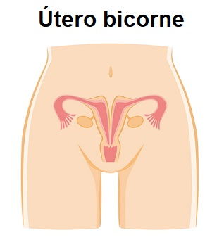 El útero bicorne es uno de los motivos por los que no se consigue el embarazo natural