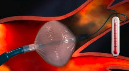 Balón empleado en la crioablación para la fibrilación auricular