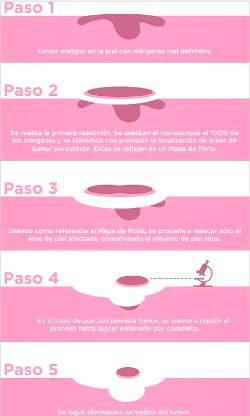 Fases de la cirugía de Mohs